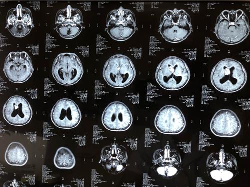 右侧侧脑室占位