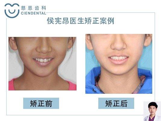 侯医生案例集——龅牙/牙错乱