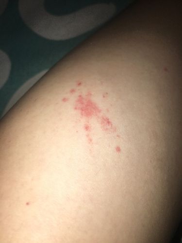 腿上起了这种红点是什么?有点痒