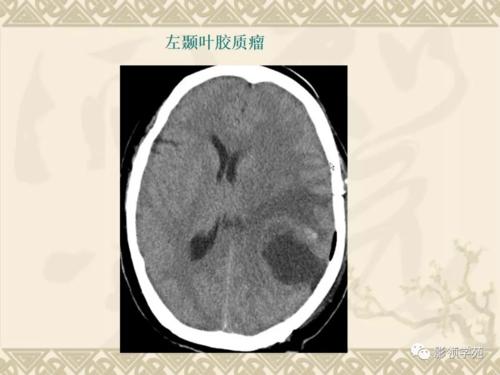 其强化原因为肿瘤新生血管及内皮细胞增生区,可反映血脑屏障破坏的