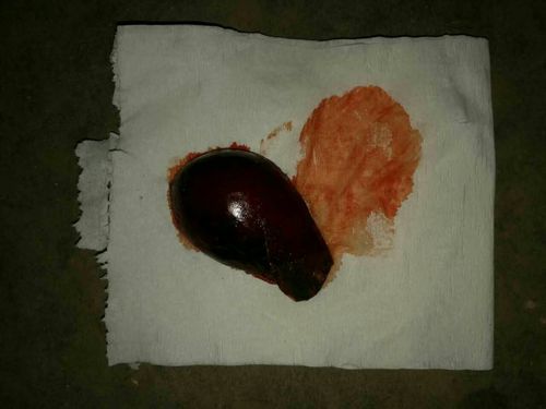 子宫肌瘤,谁割谁后悔,女人最大的悲哀莫过于此!