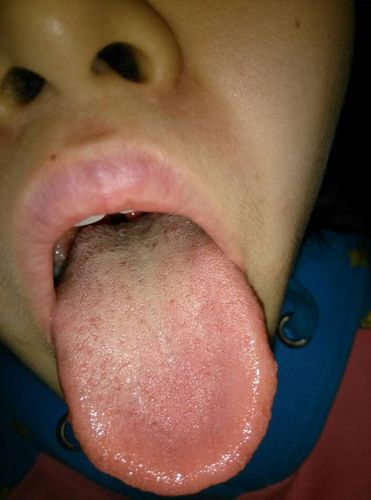 舌头上好多白点点,是为什么?舌头颜色及情