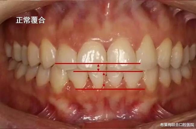 牙齿长成这个样子需要做矫正?网友:宜早不宜晚