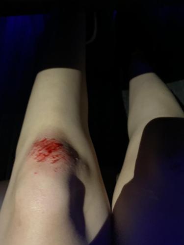 女孩子看到膝盖上有这种伤真的忍不住眼泪,而且我是疤痕体质肯定会留