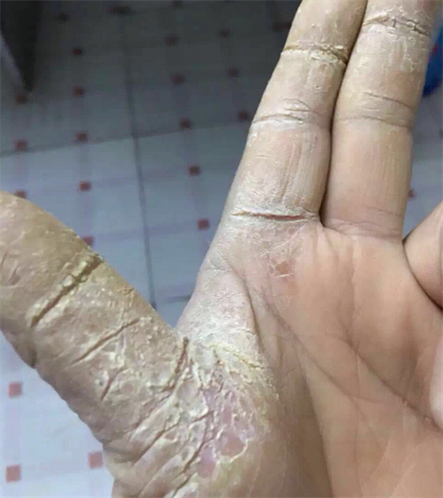 损害为红斑,水疱,鳞屑和角化增厚.