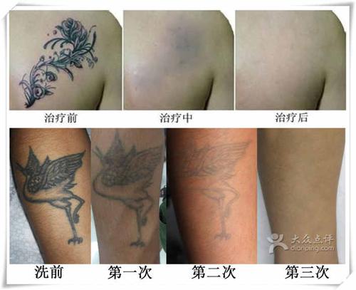 重庆洗纹身