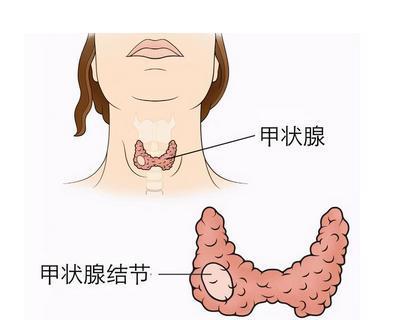 甲状腺结节早期症状有哪些7个症状表现告诉您该检查下甲状腺了