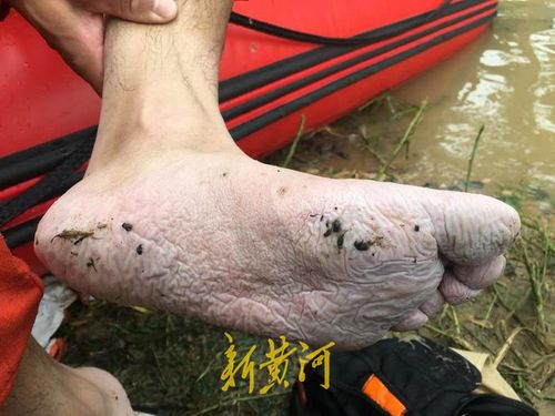 消防员的脚被泡得发白