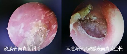 5,常见的疾病会让耳朵瘙痒 常见的如外耳道 湿疹 ,外耳道霉菌.