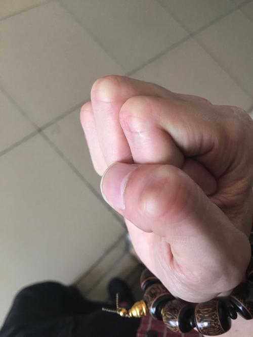 请医生看看我手指头是骨质增生还是骨刺?这个关节是的