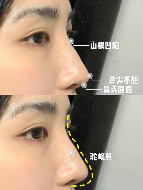 说说我做鼻子的经历,驼峰鼻宝宝看过来!