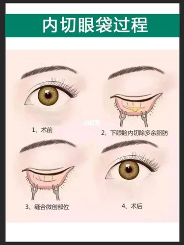 科普:祛眼袋,内切好还是外切好?