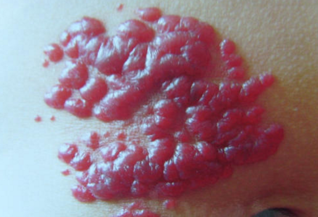 血管瘤危险吗成人血管瘤危险吗