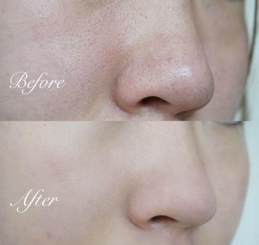 有哪些去黑头产品比较管用?推荐理由是什么?