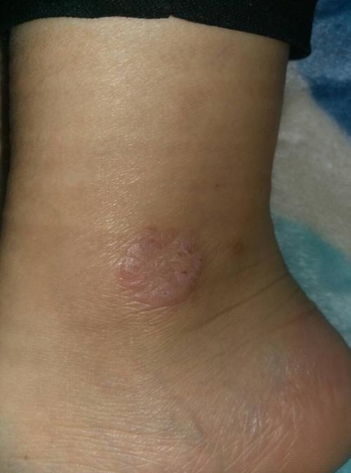 看图片,脚踝地方,起了一小片,很痒.起干皮.都好多天了也不下去.