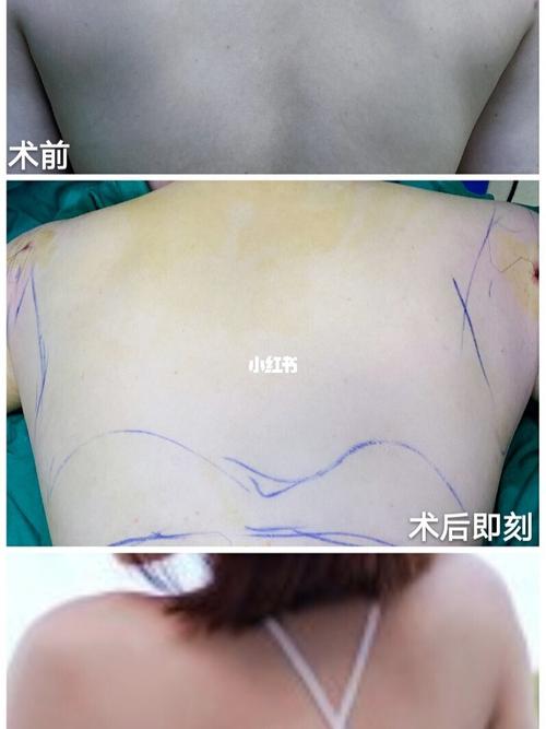 背部吸脂的痛苦经历