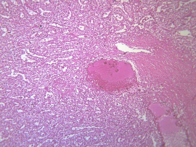 脾被膜玻璃样变 显微切片图片