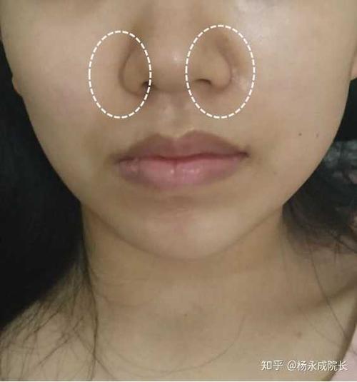这种是鼻基底凹陷嘛,我有点凸嘴 颧骨高,主要针对法令纹,什么途径如何