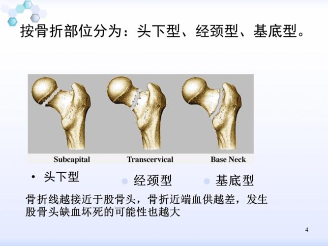 股骨颈骨折骨一科