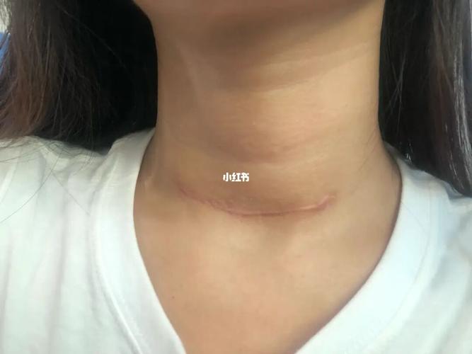 今年3月25做了甲状腺半切手术 现在已经四个月了  感觉伤口有点增生