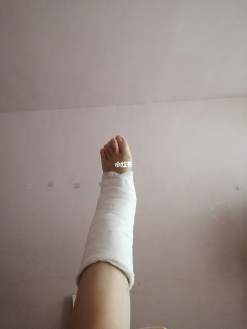 记录脚踝骨折,包上石膏的第一天_正骨_医疗健康_医疗