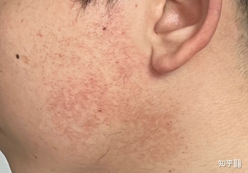 面部鸡皮肤如何改善?