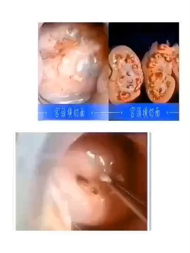 宫颈纳氏囊肿:[惊恐_医疗健康_医疗健康其他