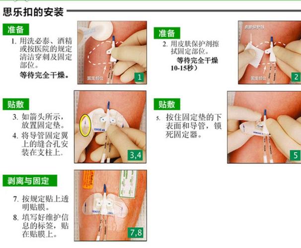 思乐扣的安装,膜下思乐扣需要每周更换.