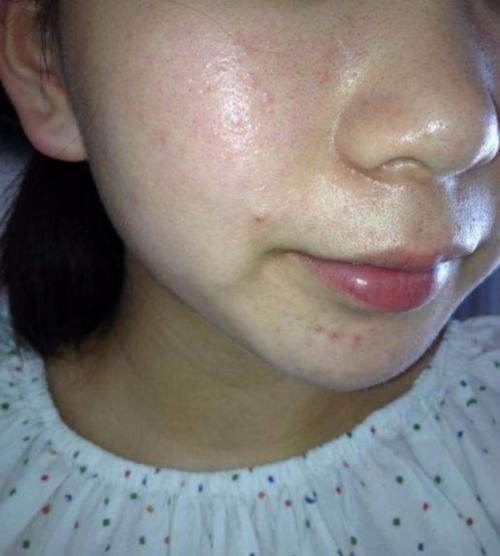 油性皮肤得时刻控油,确保肌肤的干爽舒适,才能改善粗糙,毛孔粗大,泛