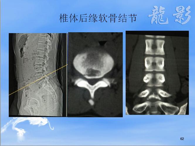 通过变薄的终板向上,下方向疝入椎体内形成的软骨结节,为腰椎间盘脱