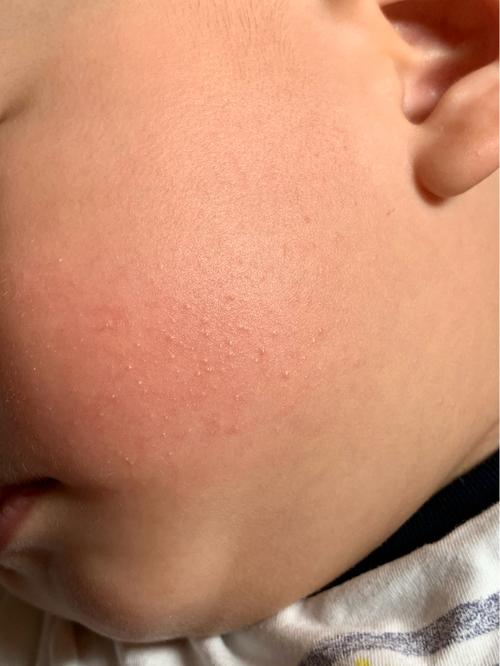 宝宝毛周角化 小疙瘩_脂肪粒_湿疹_保湿乳_母婴_育儿