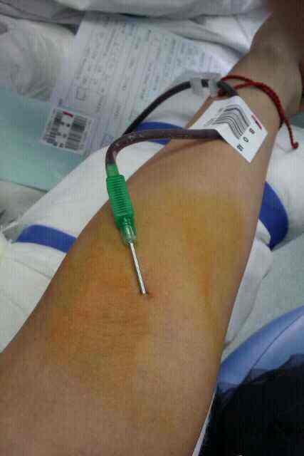 献血后注意事项,献血的针头有多粗图片