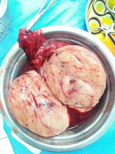 我院外一科于2019年5月10日成功完成一例"巨大睾丸肿物切除术"