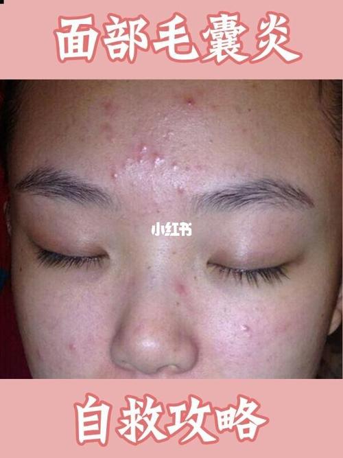 我疫情在家的时候得的毛囊炎,脸上长了一些小红疹,小白泡,我以为是