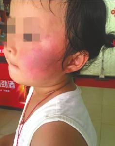 幼儿园老师让学生互扇耳光女童脸被打肿