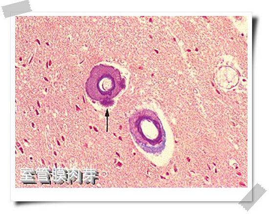 室管膜肉芽 ependymal granulation:脑室壁炎症刺激引起炎性肉芽
