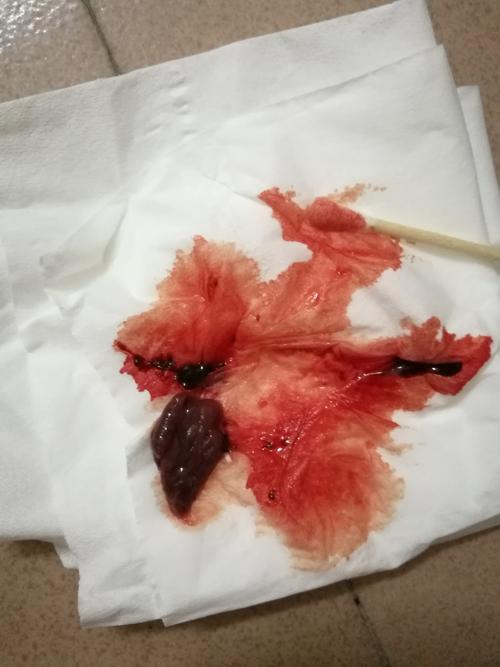 生化妊娠-其它-难孕治疗论坛-好孕帮