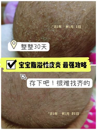 搞错了不是头垢竟然是脂溢性皮炎—_湿疹_皮炎_母乳_洗发水_药膏_贝亲