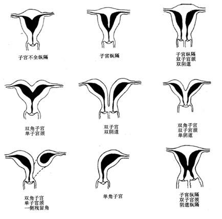 子宫畸形还能怀孕生孩子吗