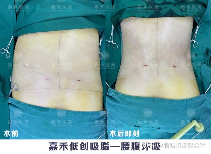 脂肪整形赵希军 的想法: 腰腹环吸,单单把脂肪吸出来,那太简单了