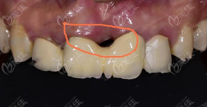 如果种植牙过了20年坏了怎么办?还能再种吗?