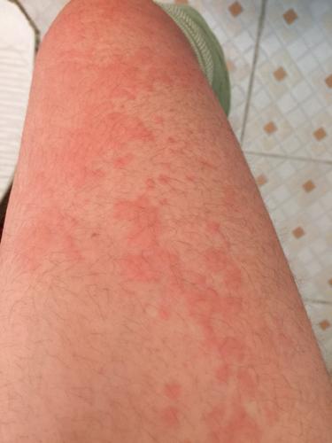大腿上都是一大片的红疙瘩,很久都没有散退,很担心是白血病的前兆