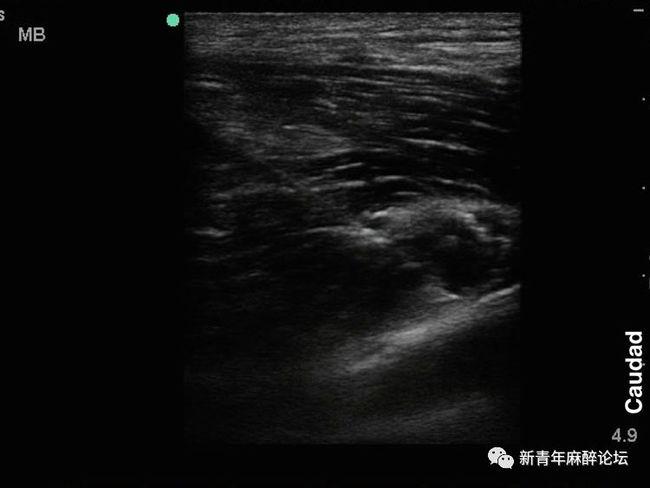 超声引导腋神经阻滞怎么做?看这里(附实战病例)