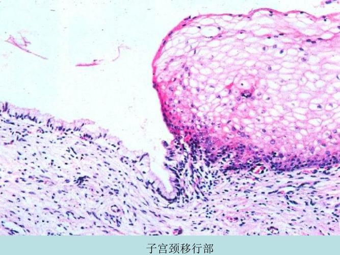 子宫颈行移部 子宫颈上皮模