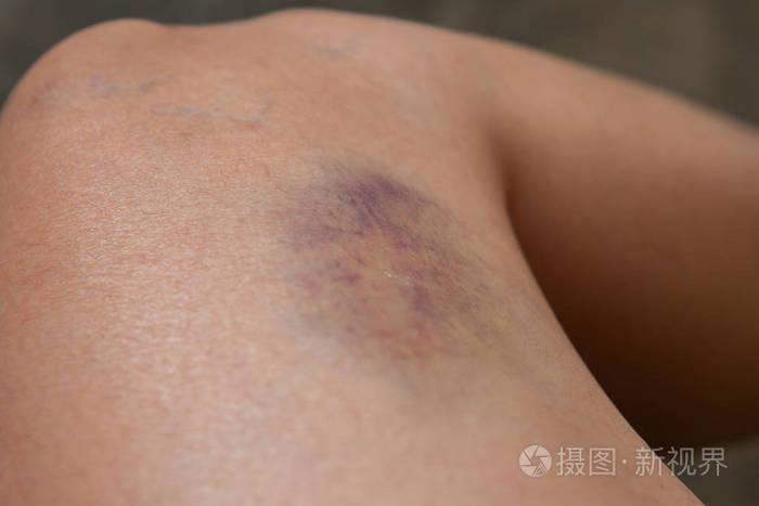 对膝关节下降所造成的划伤