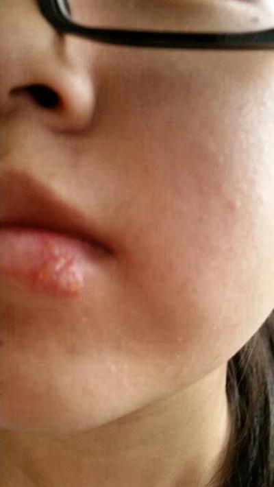 嘴唇疱疹感染图片49