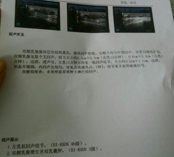 95%女性有的乳腺结节,乳腺专家来告诉你