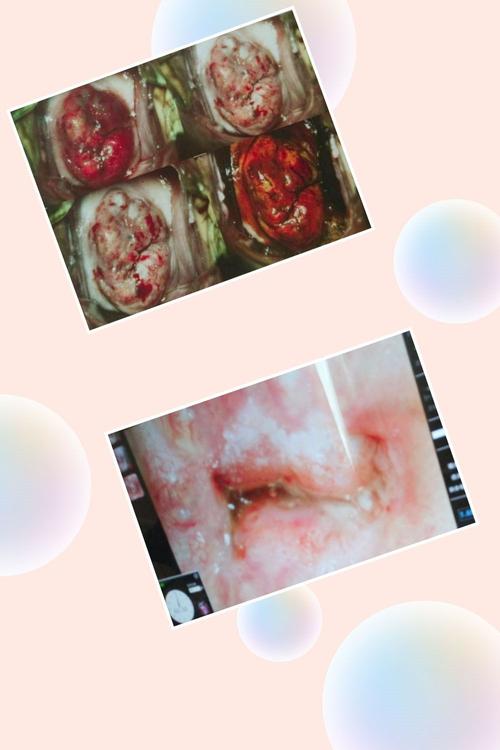 新辅助化疗联合广泛性子宫切除术为中晚期宫颈癌患者带来了一线生机