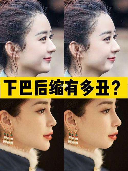 如何改善下巴后缩?_下巴后缩_变美_下巴短_美妆_医美整形