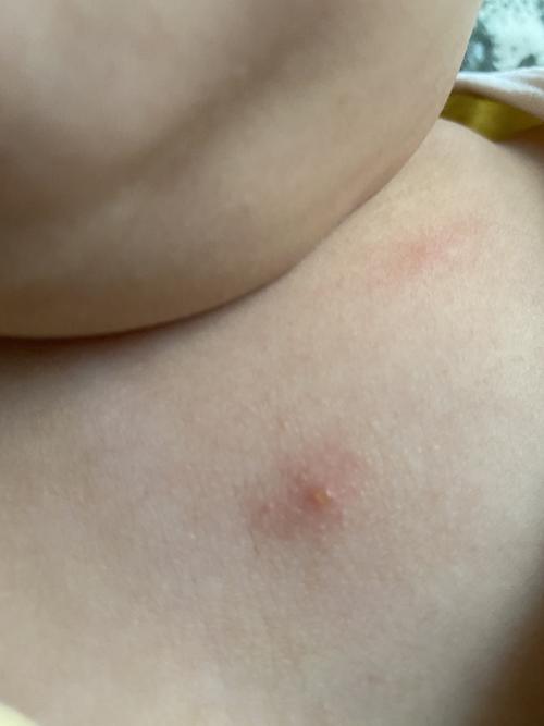 婴幼儿皮肤水泡